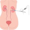 PCNL