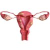 Uterine Fibroids