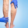 Varicose Veins
